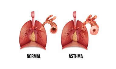 Asthma and Pneumonia: What Are the Differences