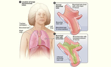 What is Acute Bronchitis