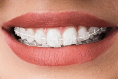 ceramic braces