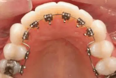 lingualbraces