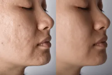 acne-treatment