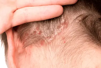 dermatological-disease