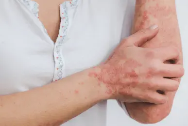 psoriasis