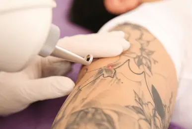 tattoo removal